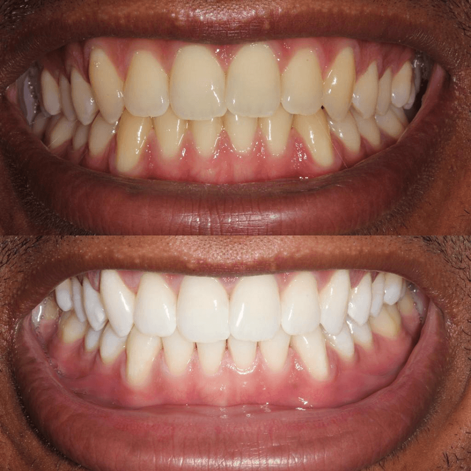 Teeth whitening before and after at Careplace Hospital, Abeokuta