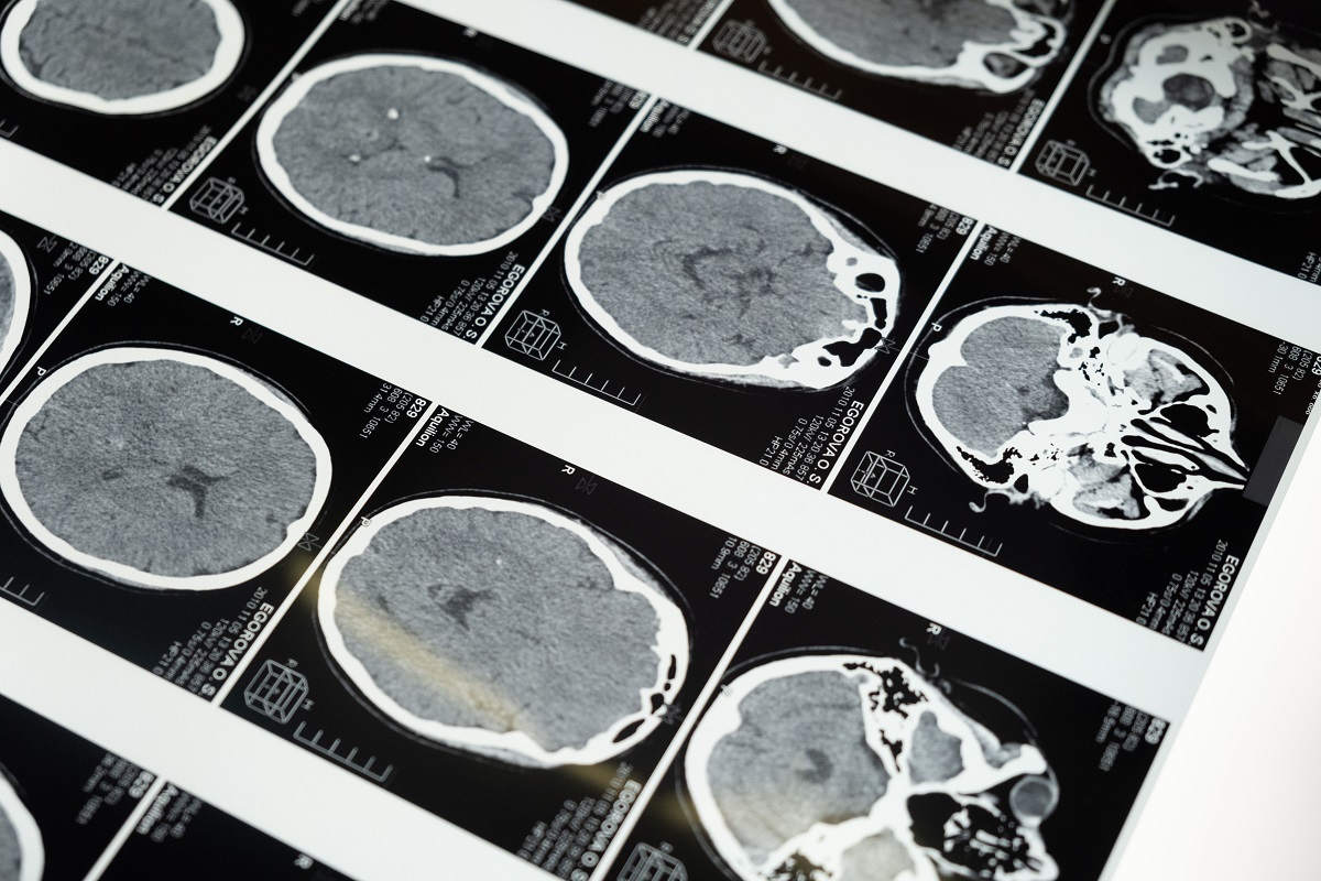 Brain CT scan images, the kind of results our neurologists can review with you